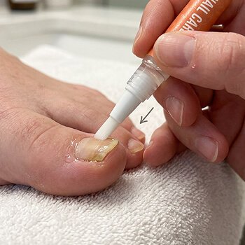 Applying FungaBeam Pen to the nail
